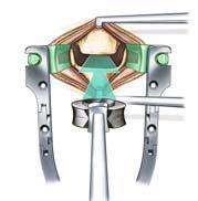 6 The Titanium implant is held securely and firmly onto the CeSpace inserter by means of a screw joint.
