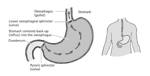 Understanding Reflux General Reflux happens when acid from the stomach washes up into the gullet (oesophagus) from the stomach.