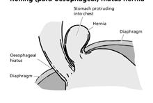 n You take medications such as ibuprofen or steroids. n You have a hiatus hernia (see below). What is a hiatus hernia?