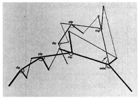 Lister GD, Klieinert HE, Kutz JE nd Atsoy E: Primry flexor repir by immedite controlled mobiliztion. J. Hnd Surg 1977;2:441.. Chow JA, Thoms LJ, Provost JM, et l.
