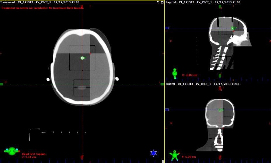 reference image is captured with AlignRT (zero offsets) Monitor patient s position during