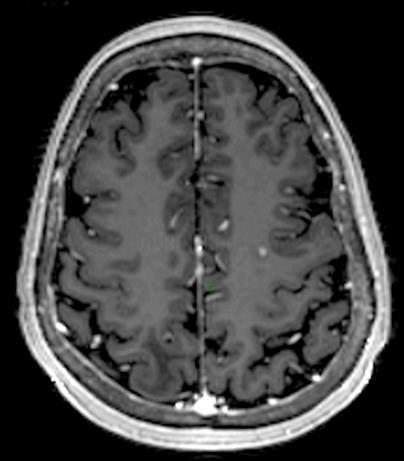Imaging 7 Metastatic MRI with