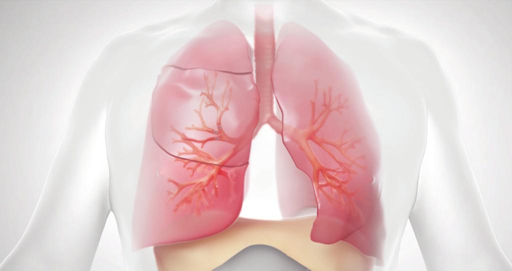 Current Treatment Options Emphysema patients often use medication, supplementary