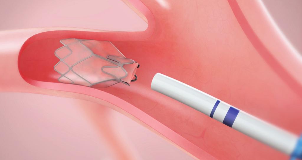 Zephyr Endobronchial Valve is an investigational device that is intended to reduce