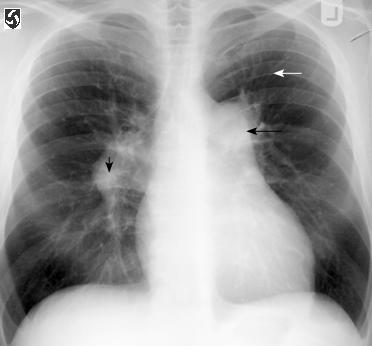 (black arrow). Peripheral pulmonary arteries are reduced in caliber.