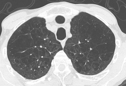 Panacinar Emphysema on CT Pt. J.C. at age 51.