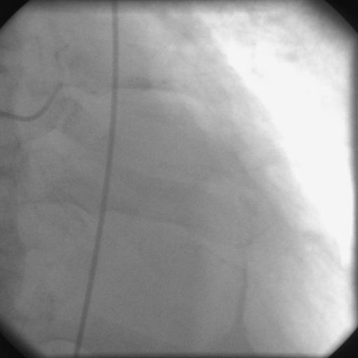 A Patient with Stent