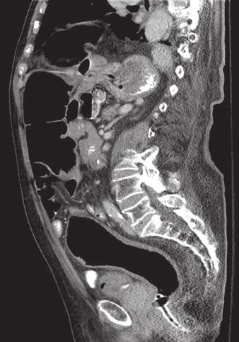 radiographic appearance of colonic obstruction depends on the competency of the ileocecal valve.