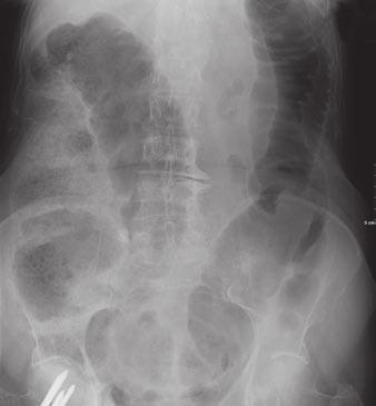 olonic Dilation Fig. 4 denocarcinoma of colon. and, Supine () and upright () abdominal radiographs show moderate distention and stool in ascending and transverse colon, along with air fluid levels.