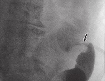 D, ontrast-enhanced T image in different patient shows dilated and stool-filled colon to level of obstructing mass (arrow).