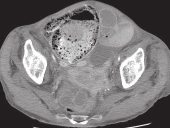 ecum is distended by dense stool, and concern for pneumatosis or ischemia was raised. Small-bowel loops are distended with fluid because of obstruction, and there is small amount of free pelvic fluid.