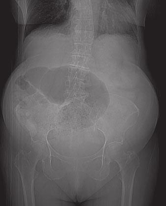 Rectal tube was placed in this patient but did not provide symptomatic relief.