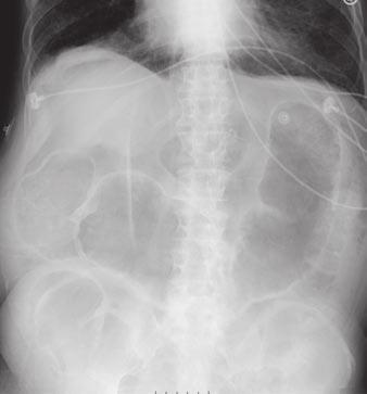 olon remains distended, and gas is seen on both sides of bowel wall (Rigler sign).