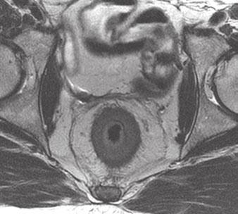 D and E, Sagittal (D) and axial (E) T2-weighted images with rectally administered