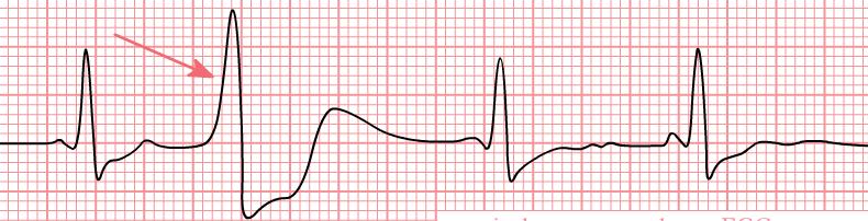 Persistent AF 1. Continuous AF Permanent AF 1. Continuous AF, with no expectation of restoring sinus rhythm 6. Sx / sn 1. Fatigue, dizziness, exertional dyspnea 2. Palpitations, angina, syncope 3.