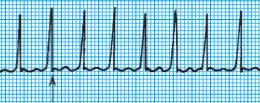9. Paroxysmal supraventricular tachycardia 1. AV nodal reentrant tachycardia 2. Orthodromic AV reentrant tachycardia 3. Cx 1.