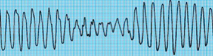 Cardiogenic shock sn Cannon A waves in neck 6. S1 varying in intensity 4. Nonsustained VT 1. Brief, self-limited runs of VT 2. Asymptomatic 3.