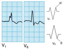 R wave in lead V6 2. 18. Right bundle branch block 1. ECG 1. QRS > 0.12s 2. Septum depolarizes normally, left to right 1. Tiny R wave in lead V1 2. Small septal Q wave in lead V6 3.