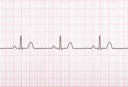 52 Chapter 4 Basic ECG Concepts and the Normal ECG The P wave should be positive in lead II and negative in av R.