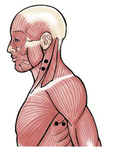 Posterior Deltoid (PDE) Upper Trapezius (UTP) approx. 2cm below the lateral border of the spine of the scapula & on an oblique angle towards the arm such that they run fibers.