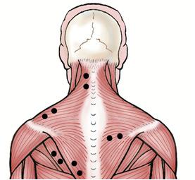 13 14 Lower Interscapular (LTP) Have the patient retract & depress the scapula & flex the arm to 90 degrees.