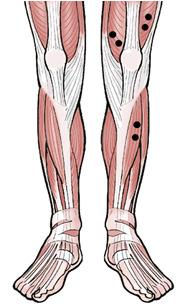 Vastus Medialis Oblique (VMO) on the distal aspect on an oblique angle (55 degrees), 2cm medial to the superior rim of the patella.