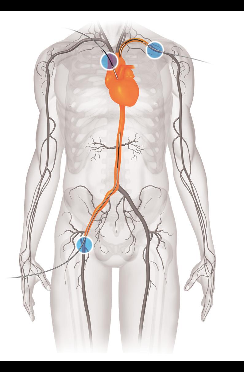 Understanding the TAVR Procedure 6 How Does the Medtronic TAVR Valve Get to My Heart? The arteries in your body are like a system of roads. They branch out from the heart.