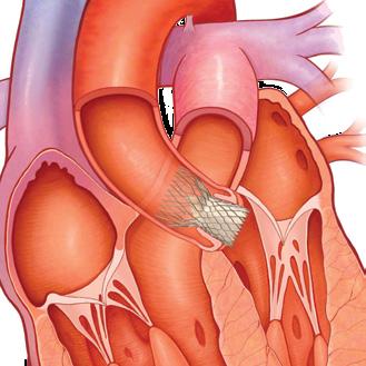 Your doctor will place the Medtronic TAVR valve in position within your own diseased heart valve or your failing surgical valve. (Figures 1 and 2) 4.