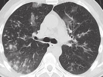 When viewed as a group, viral LRTIs tended to cause four imaging patterns: airway-centric disease (bronchitis, bronchiolitis, or bronchopneumonia) (Figs. 1 4); multifocal pneumonia (Figs.