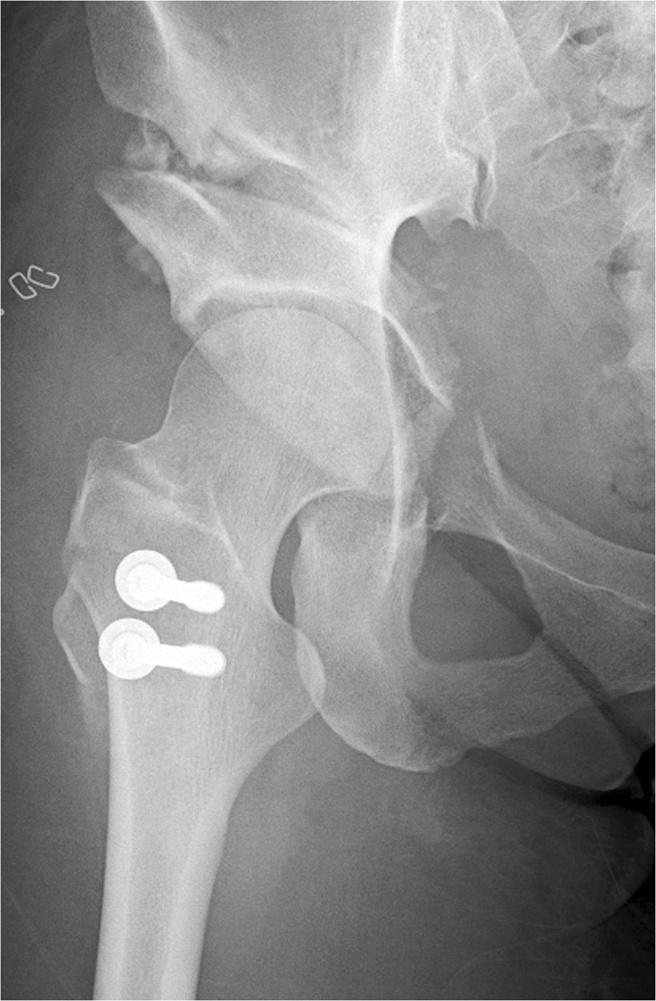 Preoperative and postoperative Harris hip scores were compared by the Wilcoxon signed rank test. The chi-square test was used for analyses of the clinical factors.