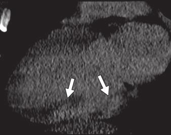 In the acute phase, the core of the MI can become necrotic as a result of profound and sustained ischemia.