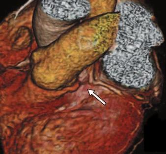 Vliegenthart et al. myocardial function and perfusion outside the context of coronary artery evaluation are likely ill conceived except for rare clinical scenarios (e.g., poor echocardiographic acoustic windows, patient with a pacemaker) because of the availability of gentler imaging modalities for these purposes.