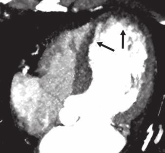 CT Technology and Techniques for Imaging the Myocardial Blood Supply and Viability CT assessment of the myocardial blood supply uses a premise similar to myocardial perfusion MRI: The contrast agents