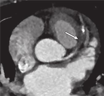 Single-Energy Coronary CT Angiography Based Techniques For the CT-based assessment of the myocardial blood supply, in general, two fundamentally very different strategies are currently in use and