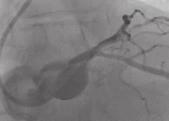 K, Invasive coronary angiography image confirms diffuse coronary