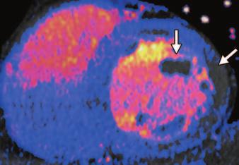 CT images are in good correlation with stress-rest SPECT images