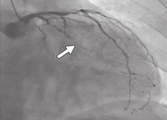based on coronary CT angiography data displays diffuse mixed