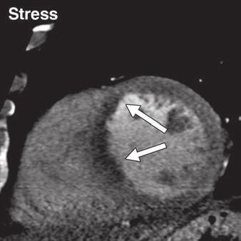 Vliegenthart et al. scan acquired during pharmacologic stress, with the goal of also detecting reversible perfusion defects (i.e., stress-induced myocardial ischemia) [32, 33, 59 64].