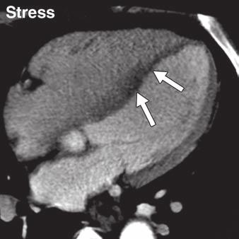 CT of Coronary Heart Disease G J Fig. 5 (continued) 75-year-old man with stable angina.