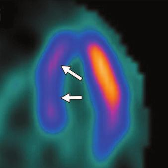 Stress MRI has a major advantage over both SPECT and CT in terms of radiation dose; however, to date MRI cannot accurately and consistently evaluate the coronary arteries.
