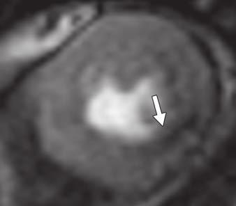 In a study of 69 patients with healed infarcts, CT detected areas of hypoattenuation in all patients