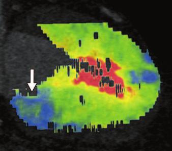 Good correlation is seen with adenosine stress perfusion MR images (G and H), which show fixed