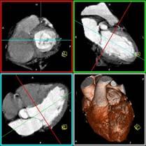 This septal or subpulmonic course has not been associated