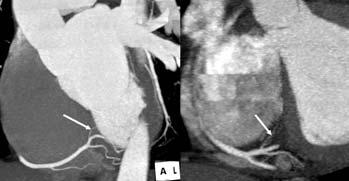 wall and inferior septum AV-Node branch