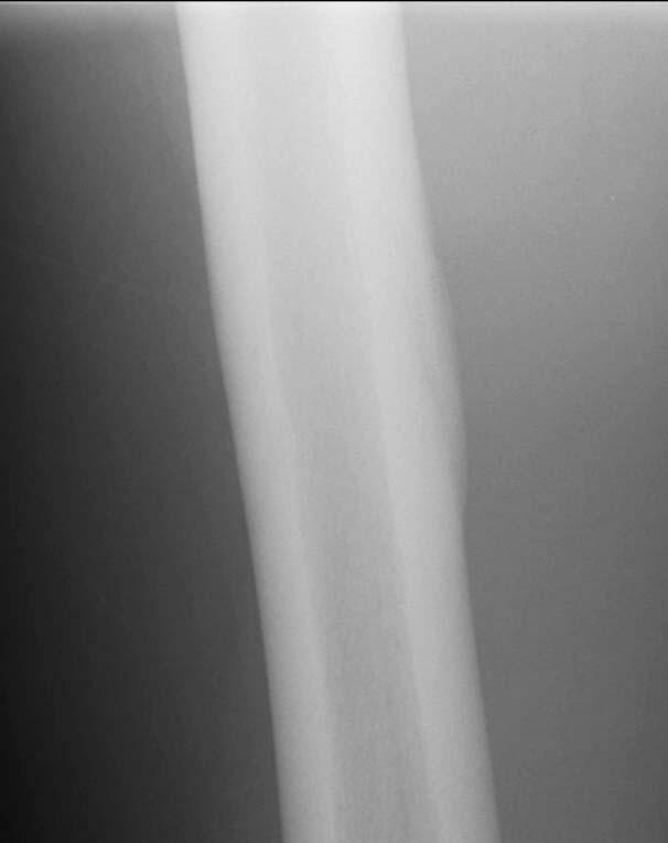 FIGURE 2. Initial radiographs of the patient in the first case report with a subtle periosteal reaction found along the medial midshaft of the right femur consistent with a stress reaction.