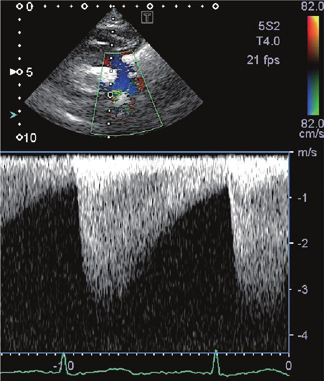 2 Case Reports in Pediatrics V1 V2 (a) (b) (c) Figure 1: (a) Continuous wave Doppler flow pattern across the coarcted segment, showing systolic flow velocity of 3.4 m/s.