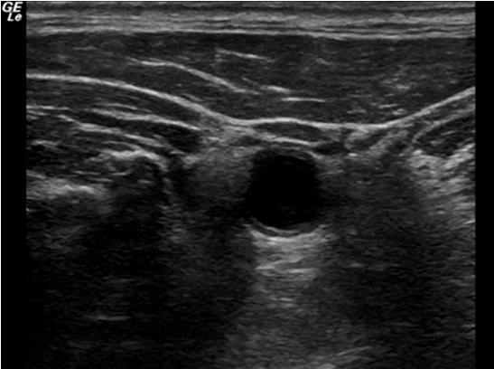 Modes of Ultrasound B-Mode: Still Image and
