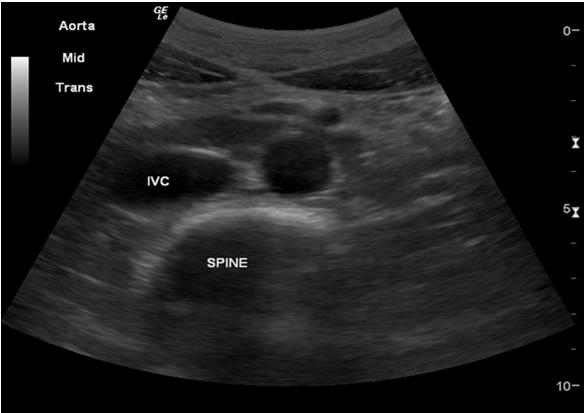 Important Imaging Principles Abdominal Ultrasound B-Mode Piezoelectric effect Brightness of the image is a function of ultrasound waves that are reflected back to the transducer Waves