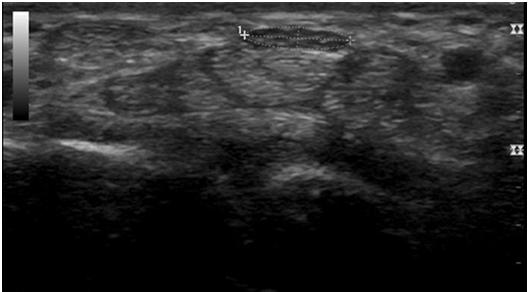 Urology 2011;78:565 Ultrasound of Carpal Tunnel Ultrasound of Carpal Tunnel Measure surface area and compare to other wrist Expanding Applications of