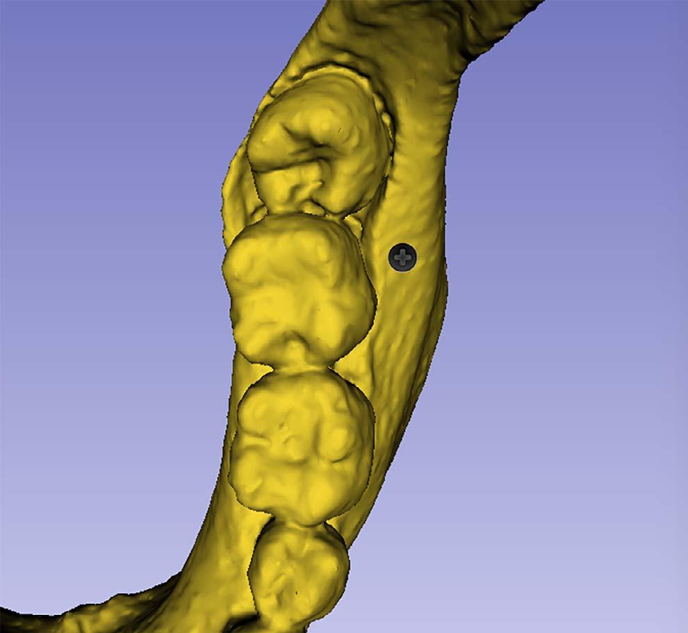 750 NUCERA, LO GIUDICE, BELLOCCHIO, SPINUZZA, CAPRIOGLIO, PERILLO, MATARESE, CORDASCO showed significntly thicker bone compred to the mesil root of the second molr on both the left nd right sides (P,.